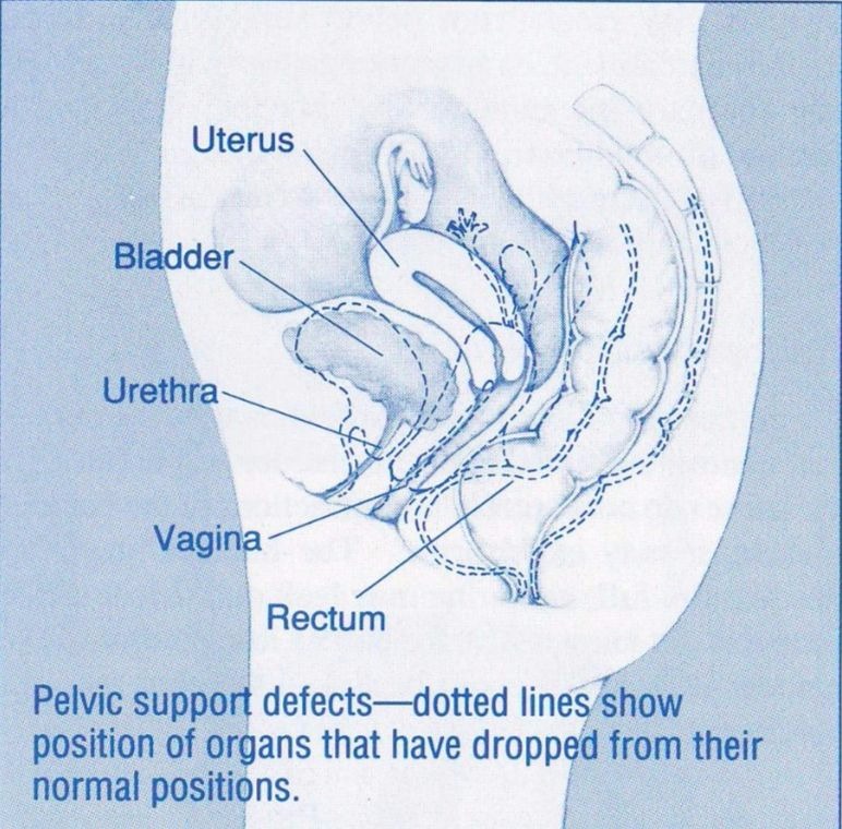 Urinary Incontinence accidental loss of urine from the bladder