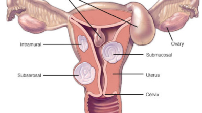 ds00078_-my00501_im01586_hdg7_fibroidlocationthu_jpg-500x400